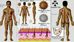 بیماری ام‌پاکس